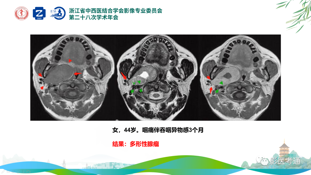 影像PPT - 【PPT】咽旁间隙病变定位与常见肿瘤性病变影像诊断-16 影像PPT - 【PPT】咽旁间隙病变定位与常见肿瘤性病变影像诊断-16