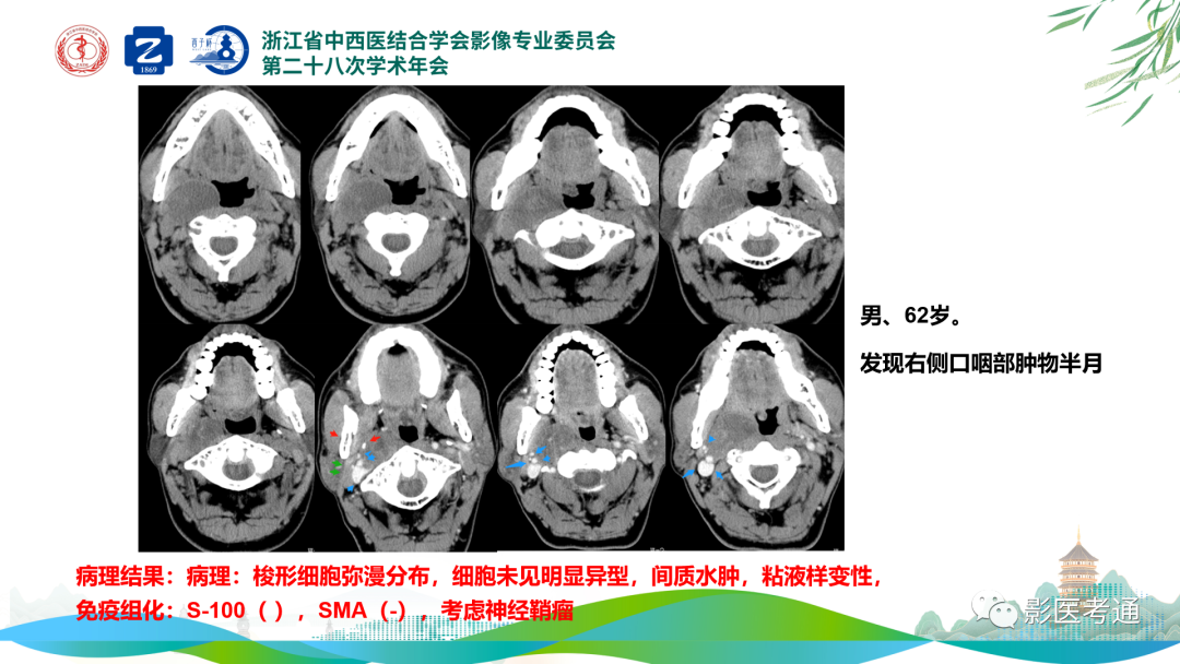 影像PPT - 【PPT】咽旁间隙病变定位与常见肿瘤性病变影像诊断-18 影像PPT - 【PPT】咽旁间隙病变定位与常见肿瘤性病变影像诊断-18