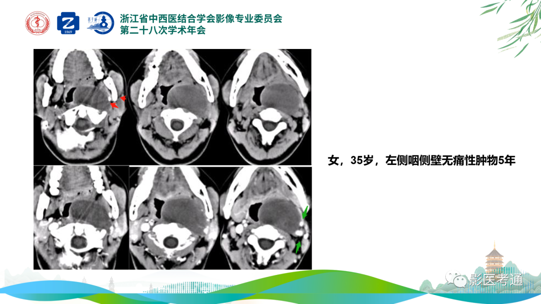 影像PPT - 【PPT】咽旁间隙病变定位与常见肿瘤性病变影像诊断-19 影像PPT - 【PPT】咽旁间隙病变定位与常见肿瘤性病变影像诊断-19