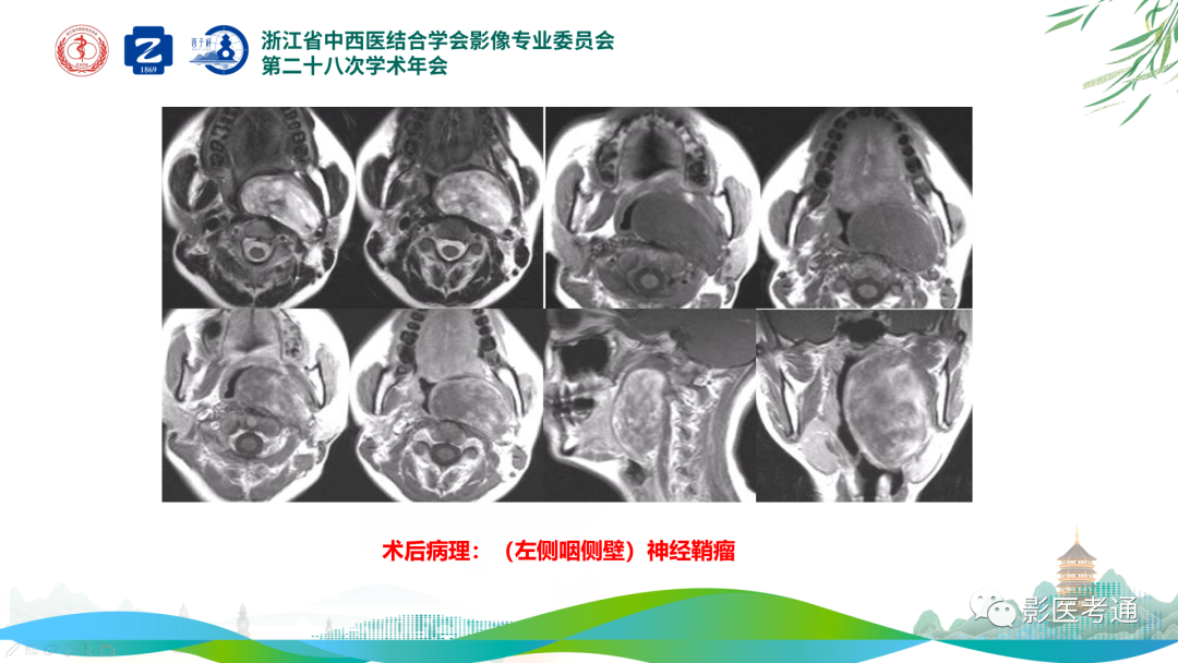 影像PPT - 【PPT】咽旁间隙病变定位与常见肿瘤性病变影像诊断-20 影像PPT - 【PPT】咽旁间隙病变定位与常见肿瘤性病变影像诊断-20