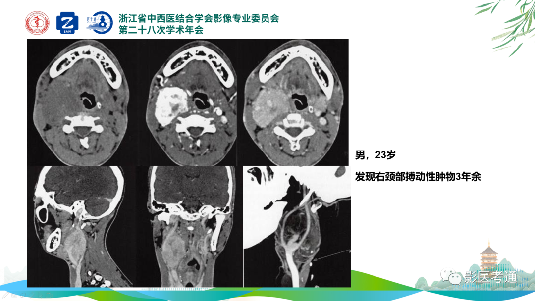 影像PPT - 【PPT】咽旁间隙病变定位与常见肿瘤性病变影像诊断-22 影像PPT - 【PPT】咽旁间隙病变定位与常见肿瘤性病变影像诊断-22