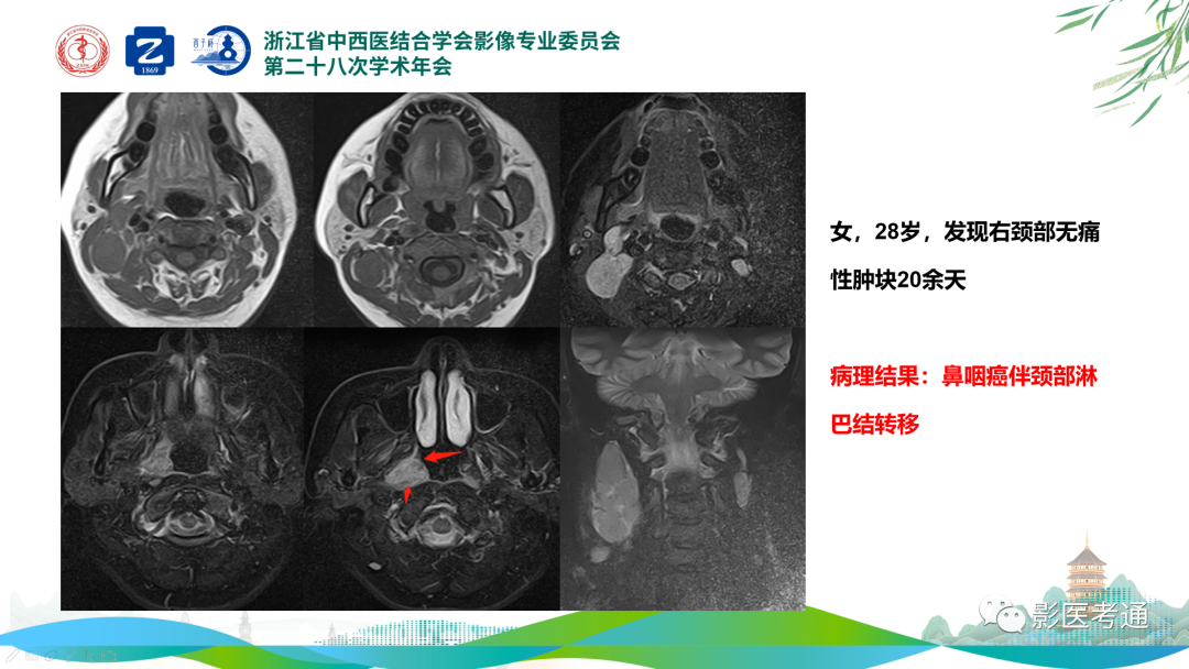 影像PPT - 【PPT】咽旁间隙病变定位与常见肿瘤性病变影像诊断-24 影像PPT - 【PPT】咽旁间隙病变定位与常见肿瘤性病变影像诊断-24