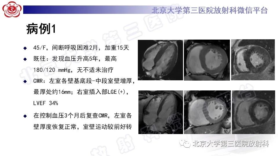 影像PPT - 【PPT】CMR在心肌肥厚中的诊断与鉴别诊断-2