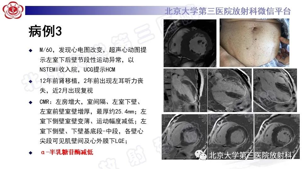 影像PPT - 【PPT】CMR在心肌肥厚中的诊断与鉴别诊断-4