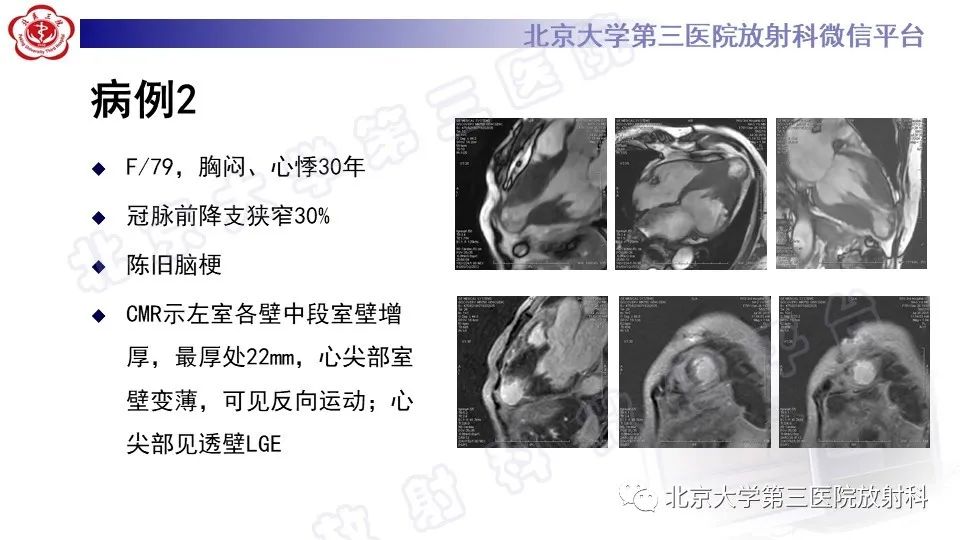 影像PPT - 【PPT】CMR在心肌肥厚中的诊断与鉴别诊断-3