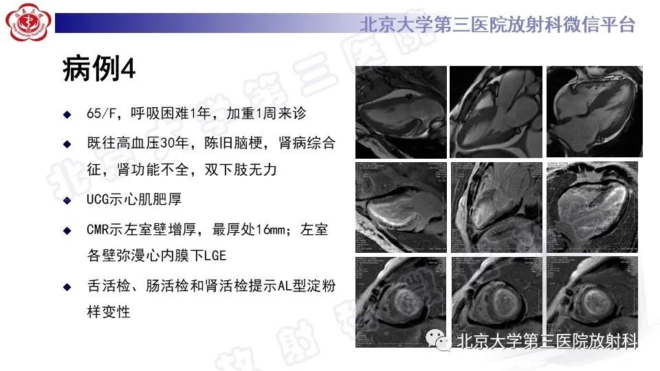 影像PPT - 【PPT】CMR在心肌肥厚中的诊断与鉴别诊断-5