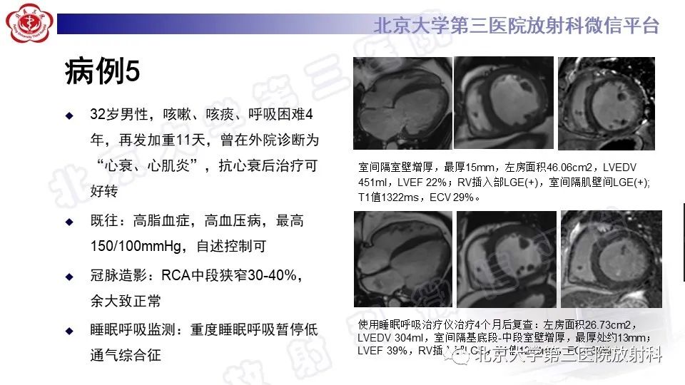 影像PPT - 【PPT】CMR在心肌肥厚中的诊断与鉴别诊断-6