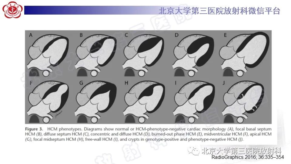 影像PPT - 【PPT】CMR在心肌肥厚中的诊断与鉴别诊断-12