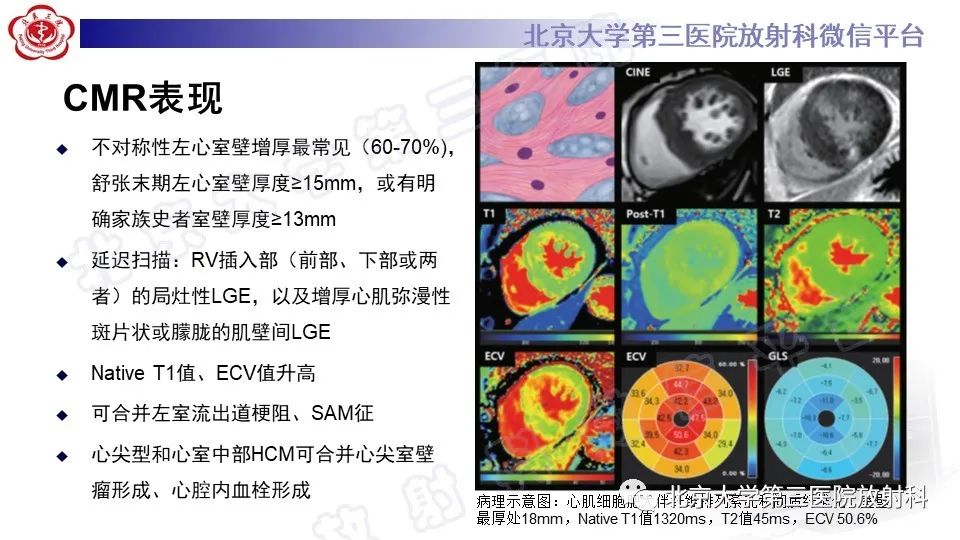 影像PPT - 【PPT】CMR在心肌肥厚中的诊断与鉴别诊断-13