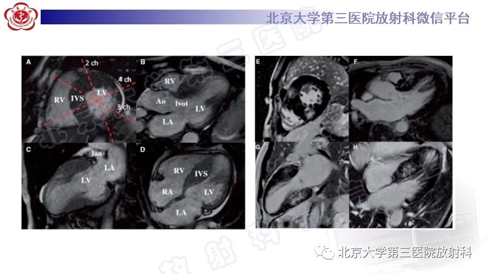 影像PPT - 【PPT】CMR在心肌肥厚中的诊断与鉴别诊断-14