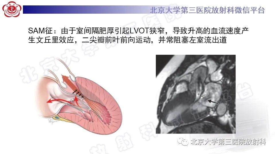 影像PPT - 【PPT】CMR在心肌肥厚中的诊断与鉴别诊断-15
