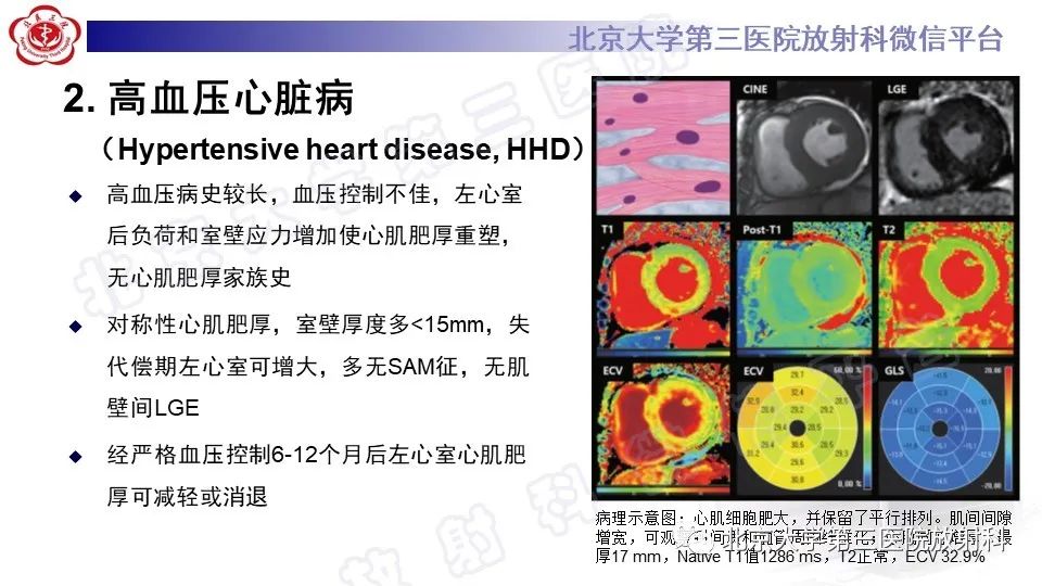 影像PPT - 【PPT】CMR在心肌肥厚中的诊断与鉴别诊断-16