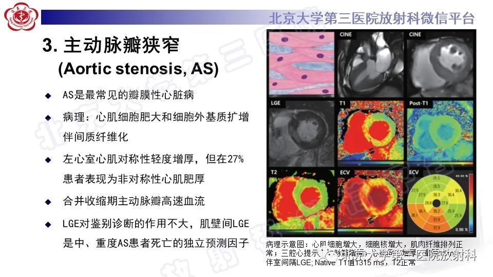 影像PPT - 【PPT】CMR在心肌肥厚中的诊断与鉴别诊断-17