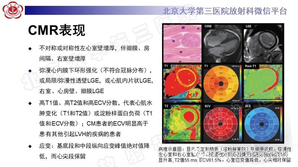 影像PPT - 【PPT】CMR在心肌肥厚中的诊断与鉴别诊断-19
