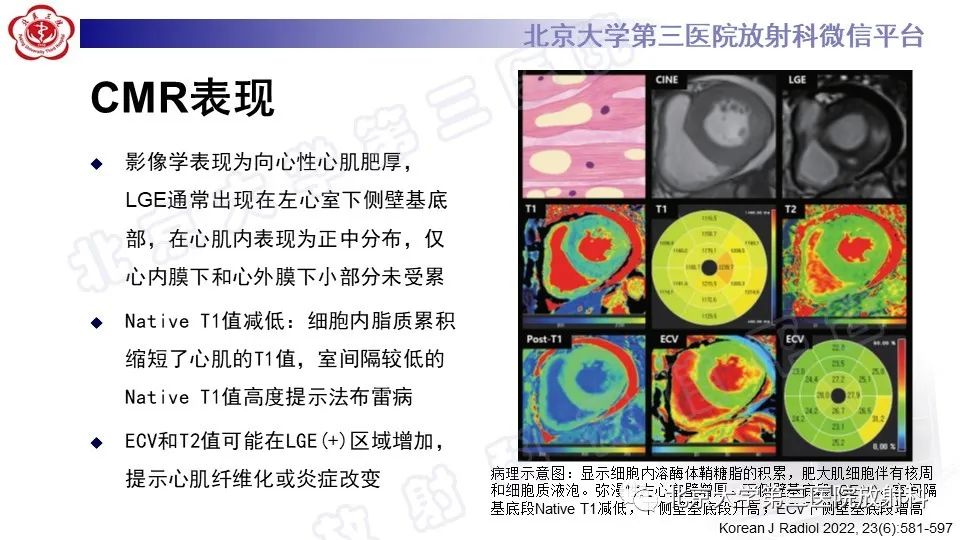 影像PPT - 【PPT】CMR在心肌肥厚中的诊断与鉴别诊断-21