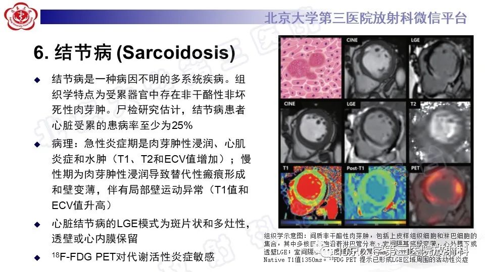 影像PPT - 【PPT】CMR在心肌肥厚中的诊断与鉴别诊断-22