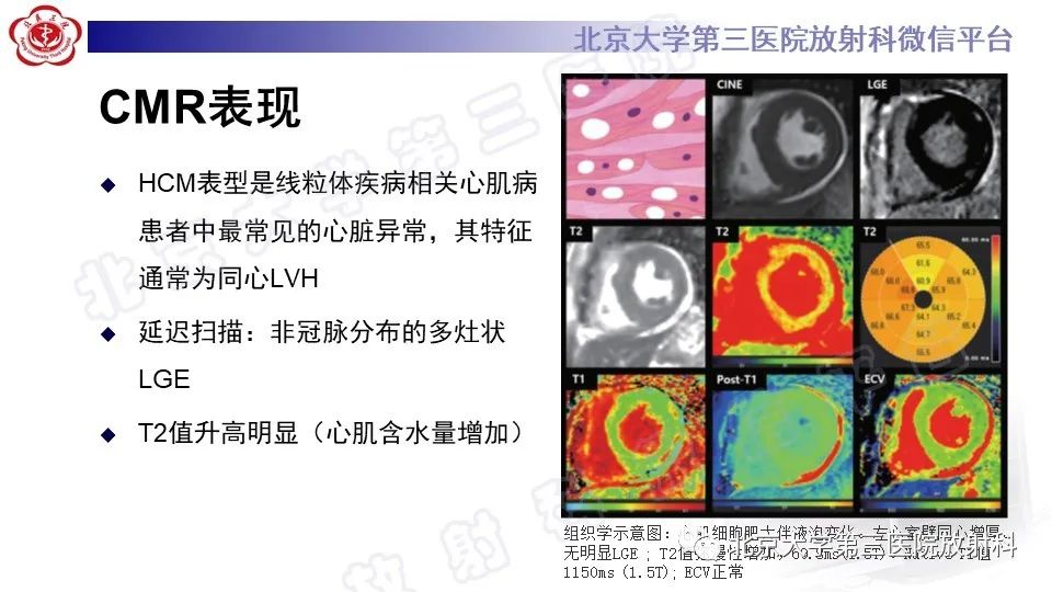 影像PPT - 【PPT】CMR在心肌肥厚中的诊断与鉴别诊断-24