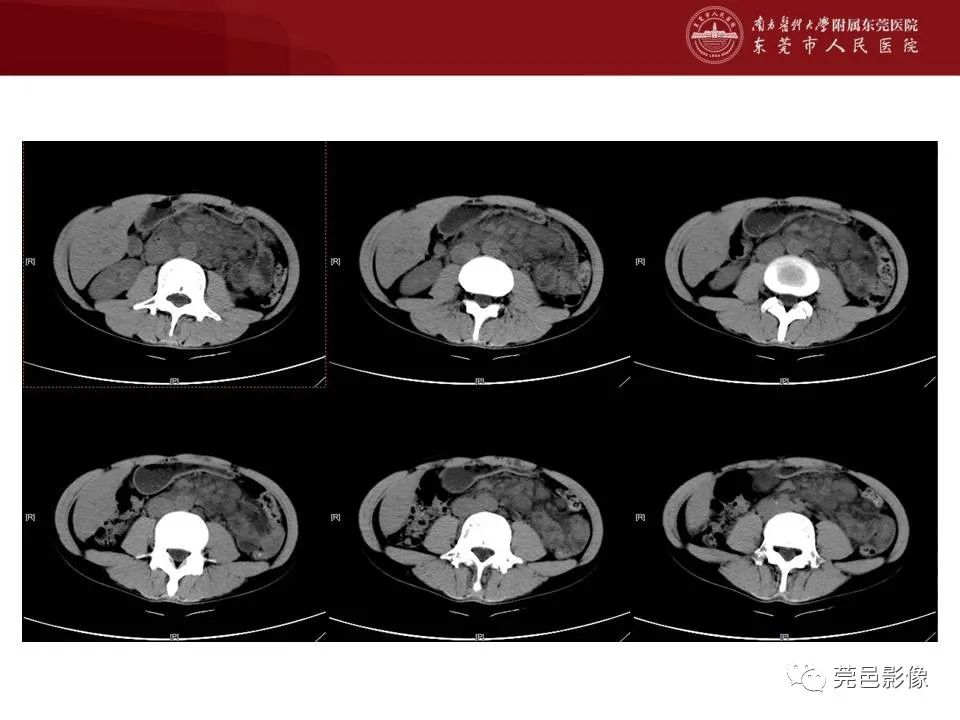影像PPT - 【病例】马尔尼菲蓝状菌感染累及淋巴结1例CT影像学表现-4