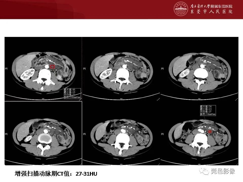 影像PPT - 【病例】马尔尼菲蓝状菌感染累及淋巴结1例CT影像学表现-6