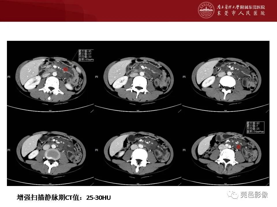 影像PPT - 【病例】马尔尼菲蓝状菌感染累及淋巴结1例CT影像学表现-8