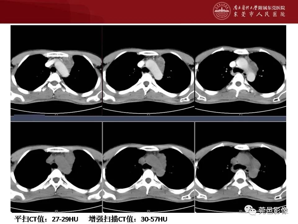 影像PPT - 【病例】马尔尼菲蓝状菌感染累及淋巴结1例CT影像学表现-12