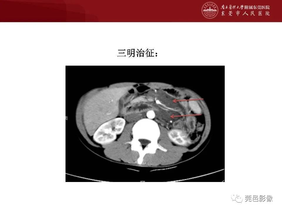 影像PPT - 【病例】马尔尼菲蓝状菌感染累及淋巴结1例CT影像学表现-18