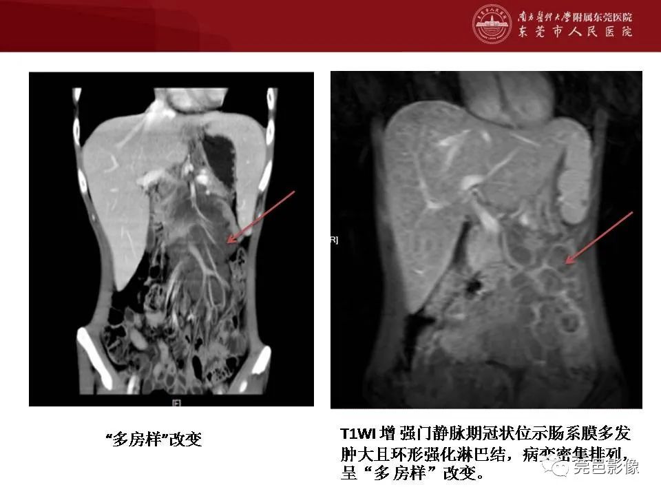 影像PPT - 【病例】马尔尼菲蓝状菌感染累及淋巴结1例CT影像学表现-20
