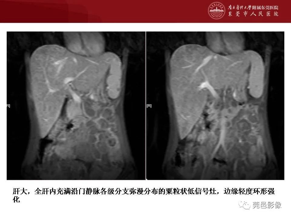 影像PPT - 【病例】马尔尼菲蓝状菌感染累及淋巴结1例CT影像学表现-23