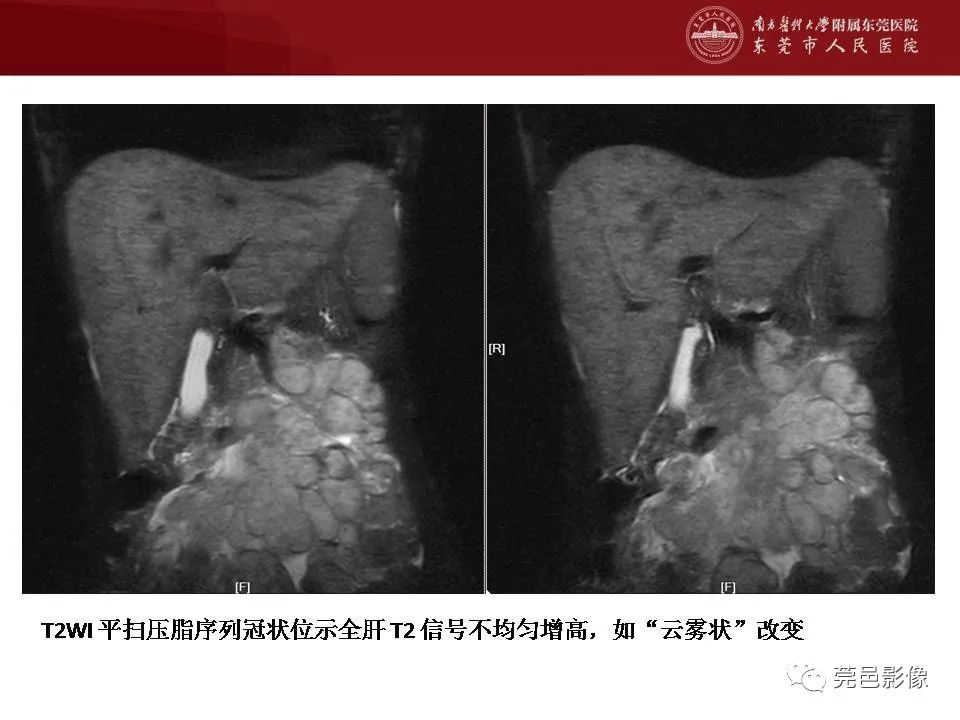 影像PPT - 【病例】马尔尼菲蓝状菌感染累及淋巴结1例CT影像学表现-24