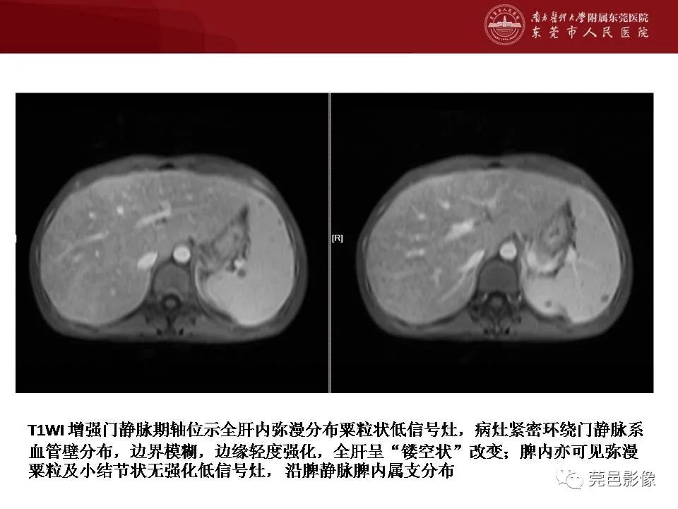 影像PPT - 【病例】马尔尼菲蓝状菌感染累及淋巴结1例CT影像学表现-25