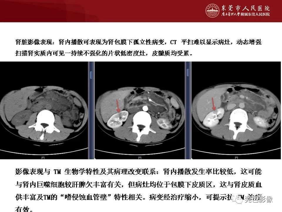 影像PPT - 【病例】马尔尼菲蓝状菌感染累及淋巴结1例CT影像学表现-27