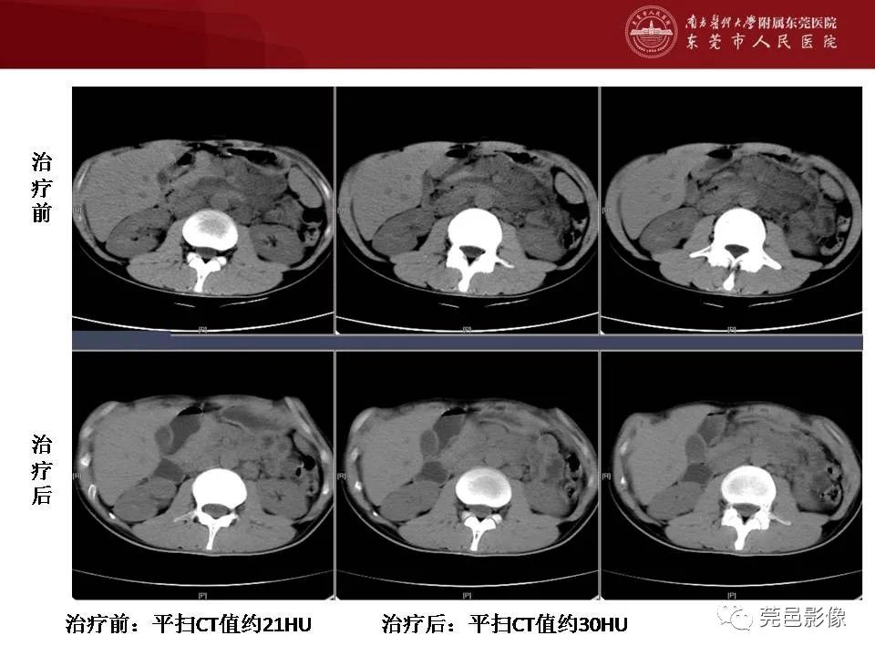 影像PPT - 【病例】马尔尼菲蓝状菌感染累及淋巴结1例CT影像学表现-30