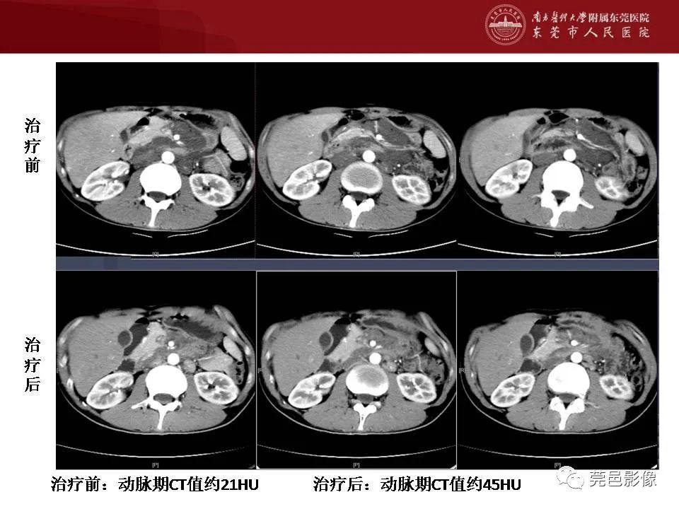 影像PPT - 【病例】马尔尼菲蓝状菌感染累及淋巴结1例CT影像学表现-31