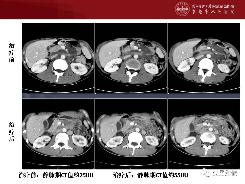 影像PPT - 【病例】马尔尼菲蓝状菌感染累及淋巴结1例CT影像学表现-32