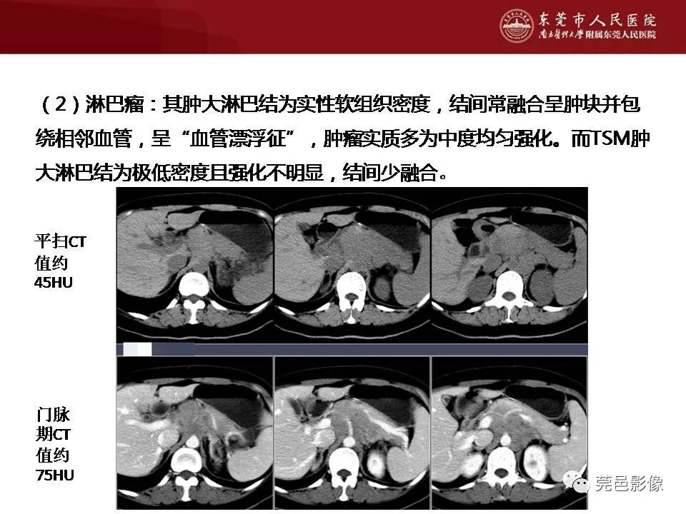 影像PPT - 【病例】马尔尼菲蓝状菌感染累及淋巴结1例CT影像学表现-39