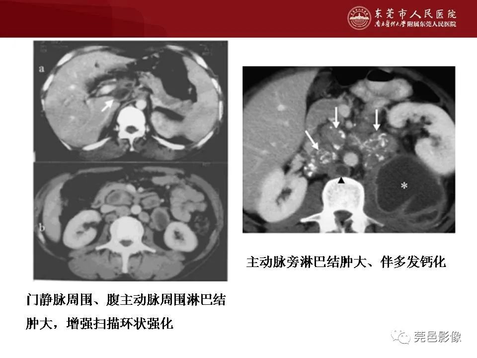 影像PPT - 【病例】马尔尼菲蓝状菌感染累及淋巴结1例CT影像学表现-38