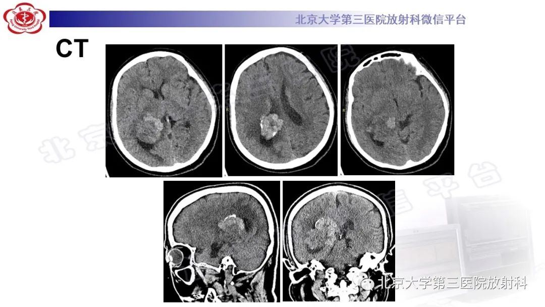 影像PPT - 【PPT】颅内孤立性纤维性肿瘤/血管外皮瘤（SFT/HPC）-3