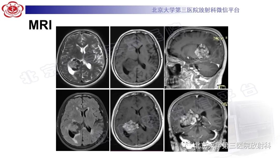 影像PPT - 【PPT】颅内孤立性纤维性肿瘤/血管外皮瘤（SFT/HPC）-5