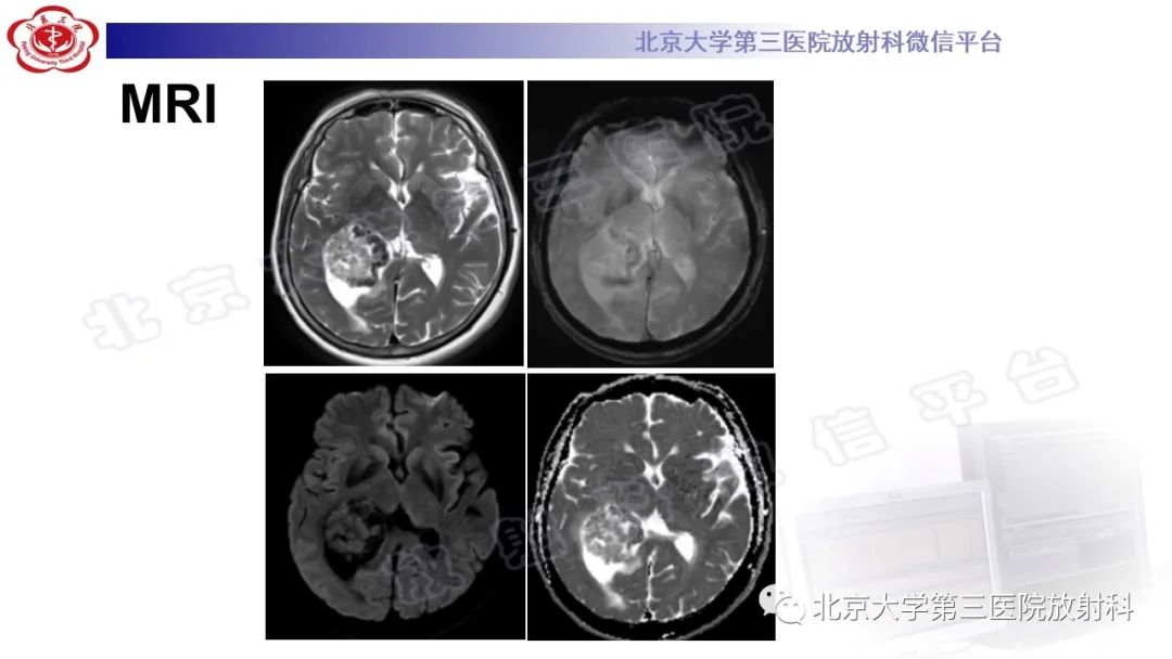 影像PPT - 【PPT】颅内孤立性纤维性肿瘤/血管外皮瘤（SFT/HPC）-6