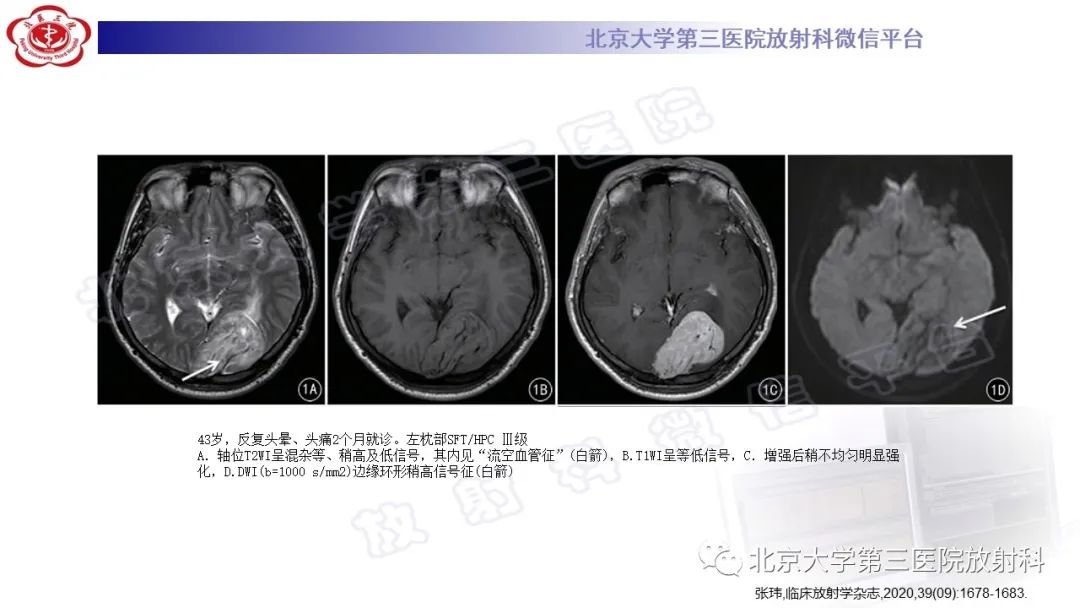 影像PPT - 【PPT】颅内孤立性纤维性肿瘤/血管外皮瘤（SFT/HPC）-17