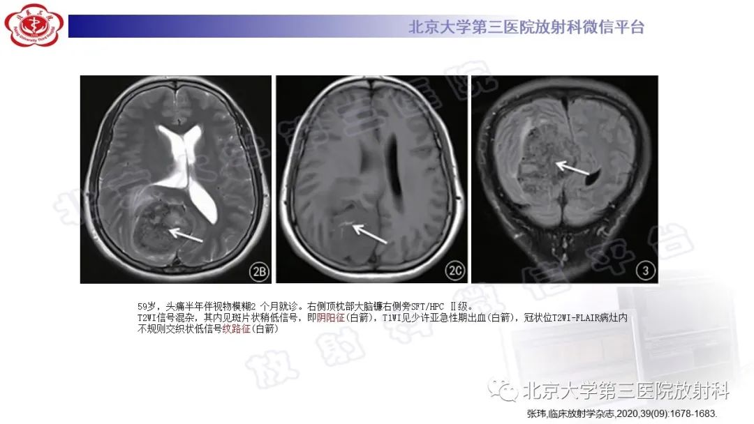影像PPT - 【PPT】颅内孤立性纤维性肿瘤/血管外皮瘤（SFT/HPC）-18