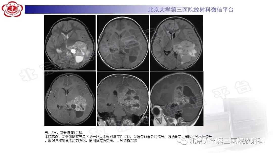 影像PPT - 【PPT】颅内孤立性纤维性肿瘤/血管外皮瘤（SFT/HPC）-21