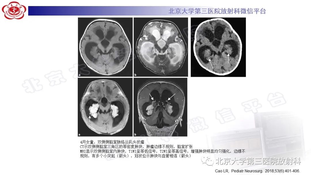 影像PPT - 【PPT】颅内孤立性纤维性肿瘤/血管外皮瘤（SFT/HPC）-25