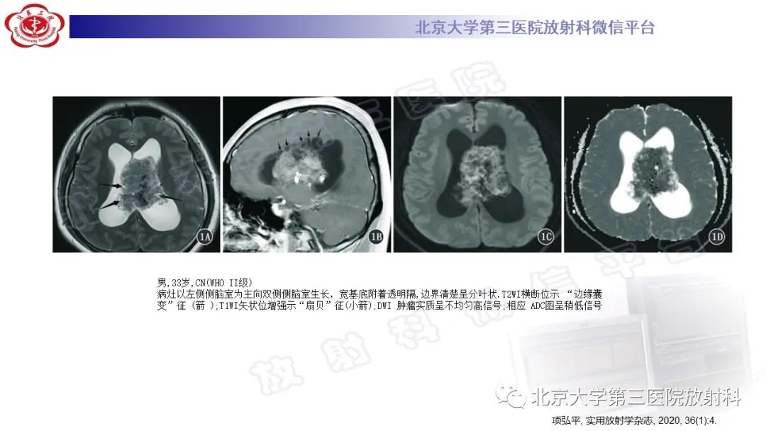 影像PPT - 【PPT】颅内孤立性纤维性肿瘤/血管外皮瘤（SFT/HPC）-28