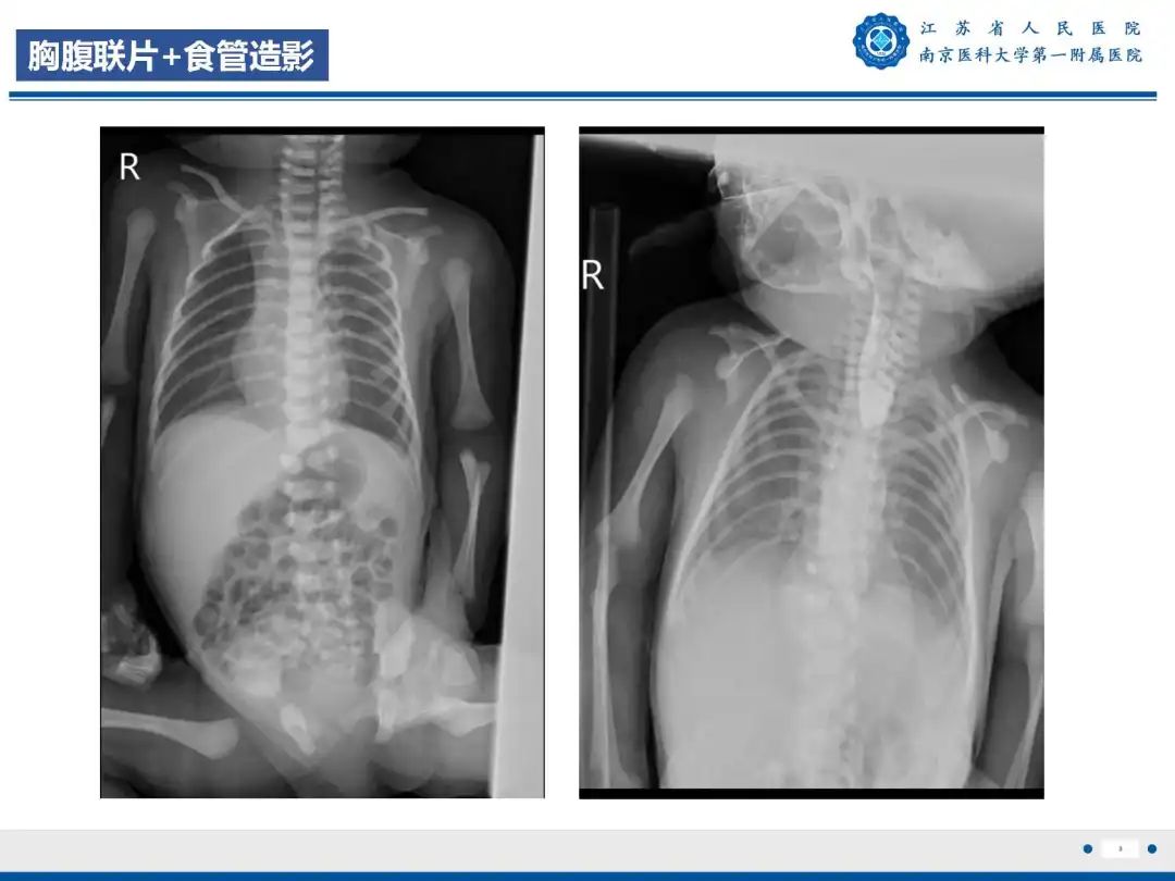 影像PPT - 【PPT】食管闭锁-3