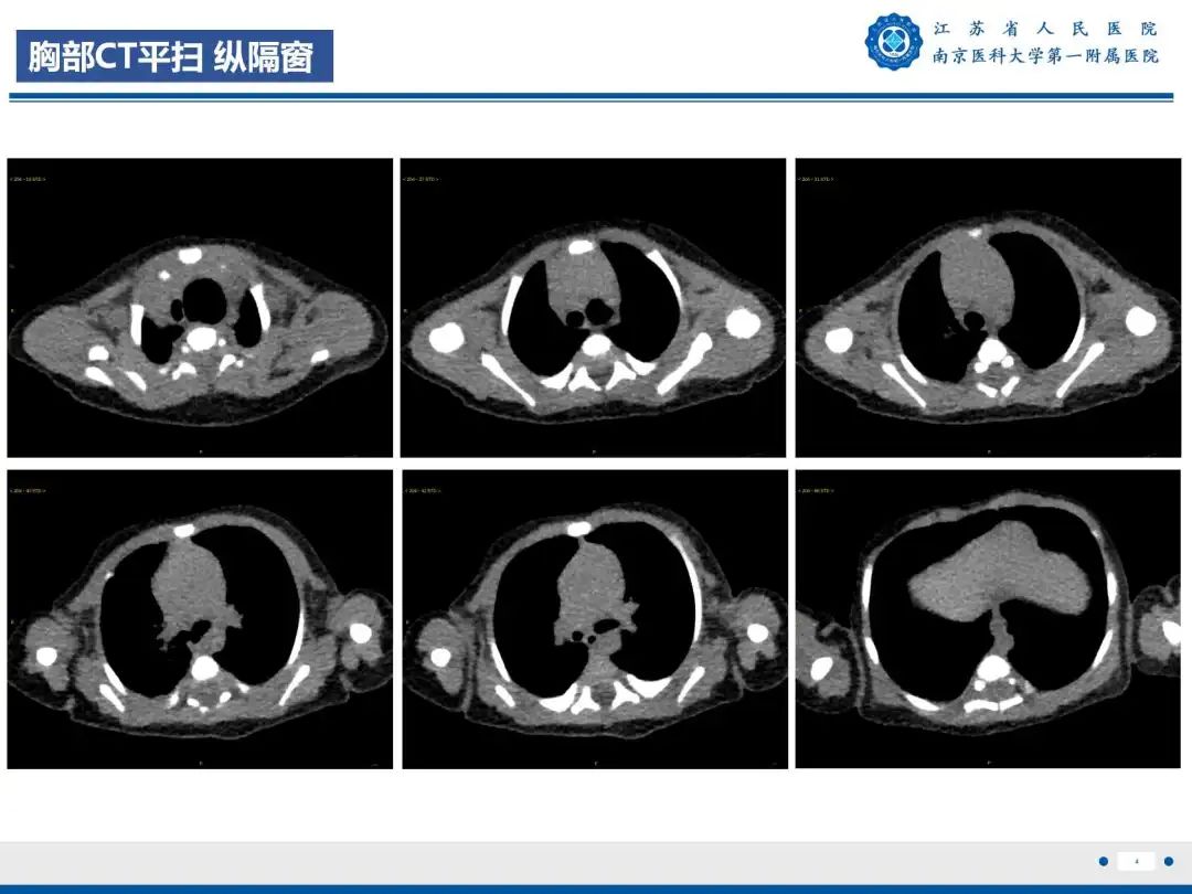影像PPT - 【PPT】食管闭锁-4