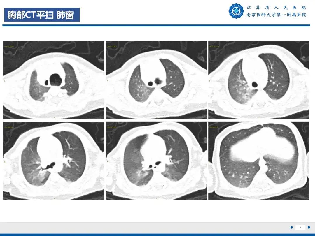 影像PPT - 【PPT】食管闭锁-5