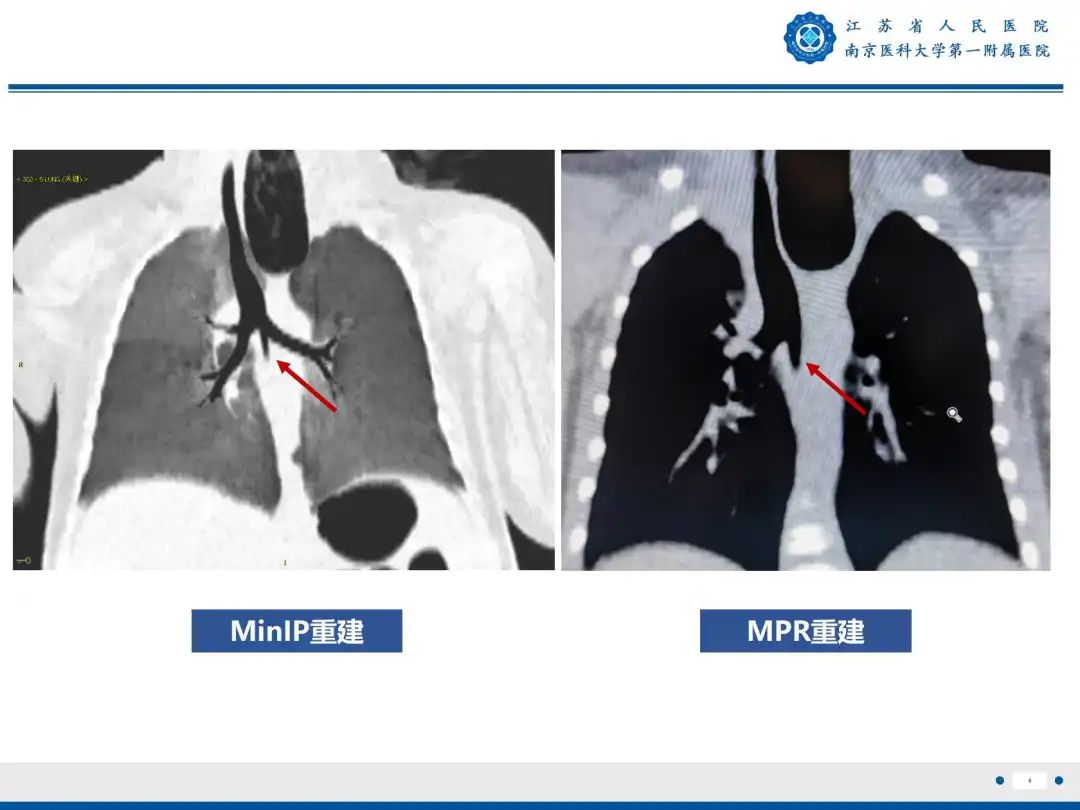 影像PPT - 【PPT】食管闭锁-6