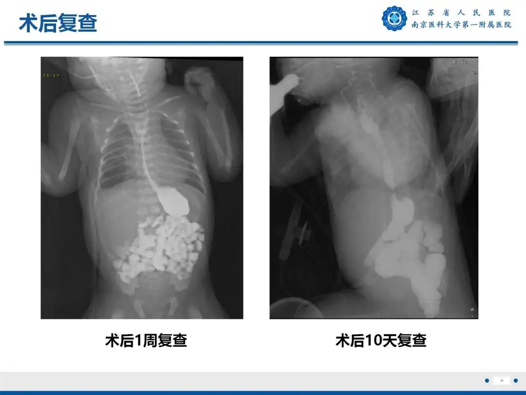 影像PPT - 【PPT】食管闭锁-13