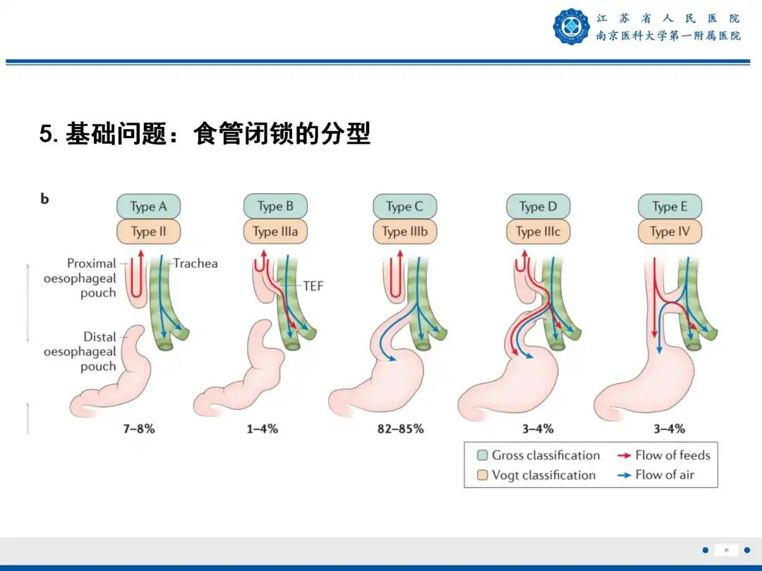 影像PPT - 【PPT】食管闭锁-21